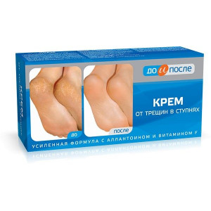 ДО И ПОСЛЕ КРЕМ Д/НОГ ОТ ТРЕЩИН В СТУПНЯХ 150МЛ. /ТВИНС ТЭК/ ДО И ПОСЛЕ КРЕМ Д/НОГ ОТ ТРЕЩИН В СТУПНЯХ 150МЛ. /ТВИНС ТЭК/